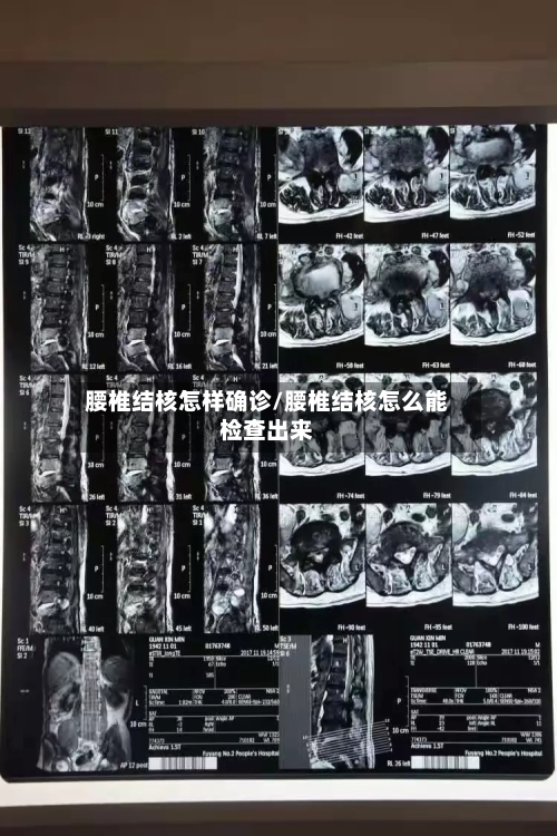 腰椎结核怎样确诊/腰椎结核怎么能检查出来