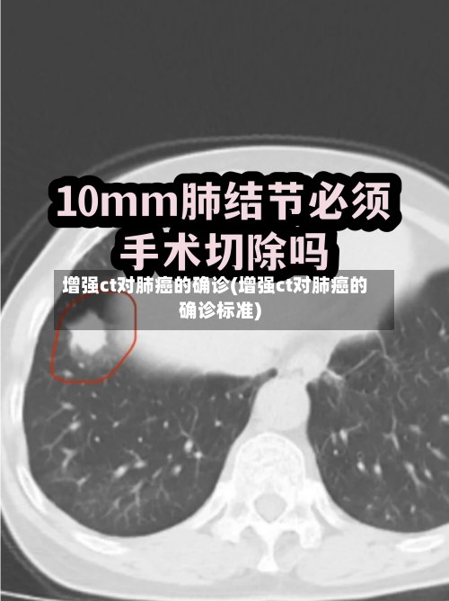 增强ct对肺癌的确诊(增强ct对肺癌的确诊标准)