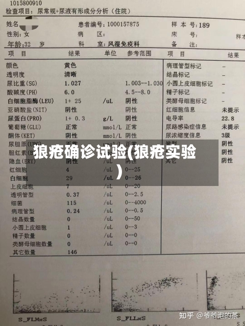 狼疮确诊试验(狼疮实验)-第2张图片