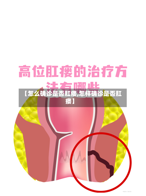 【怎么确诊是否肛瘘,怎样确诊是否肛瘘】-第3张图片
