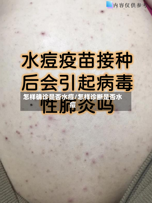 怎样确诊是否水痘/怎样诊断是否水痘-第1张图片