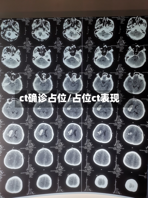 ct确诊占位/占位ct表现-第2张图片