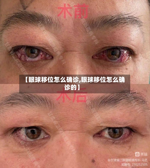 【眼球移位怎么确诊,眼球移位怎么确诊的】-第3张图片