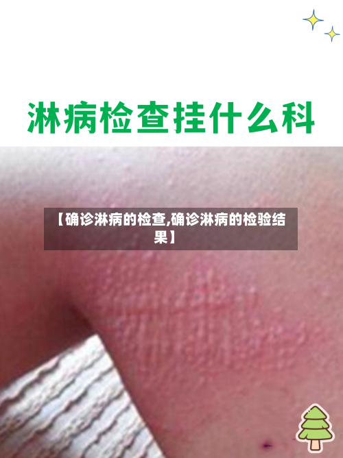 【确诊淋病的检查,确诊淋病的检验结果】-第2张图片