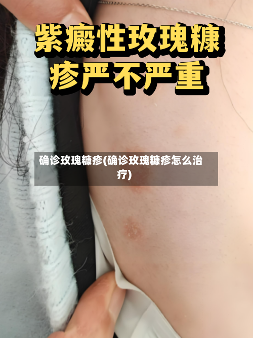 确诊玫瑰糠疹(确诊玫瑰糠疹怎么治疗)